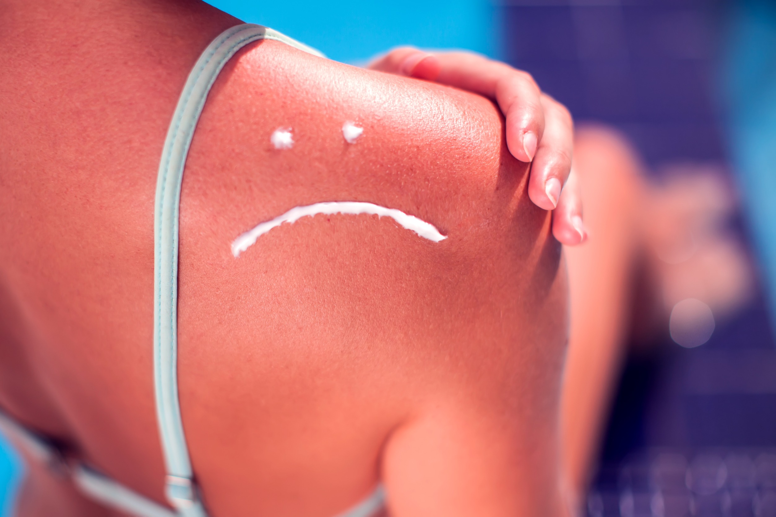 Verbrande huid door de zon? Dit kun je er tegen doen