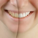 Video: Wel of niet je tanden laten bleken? 18