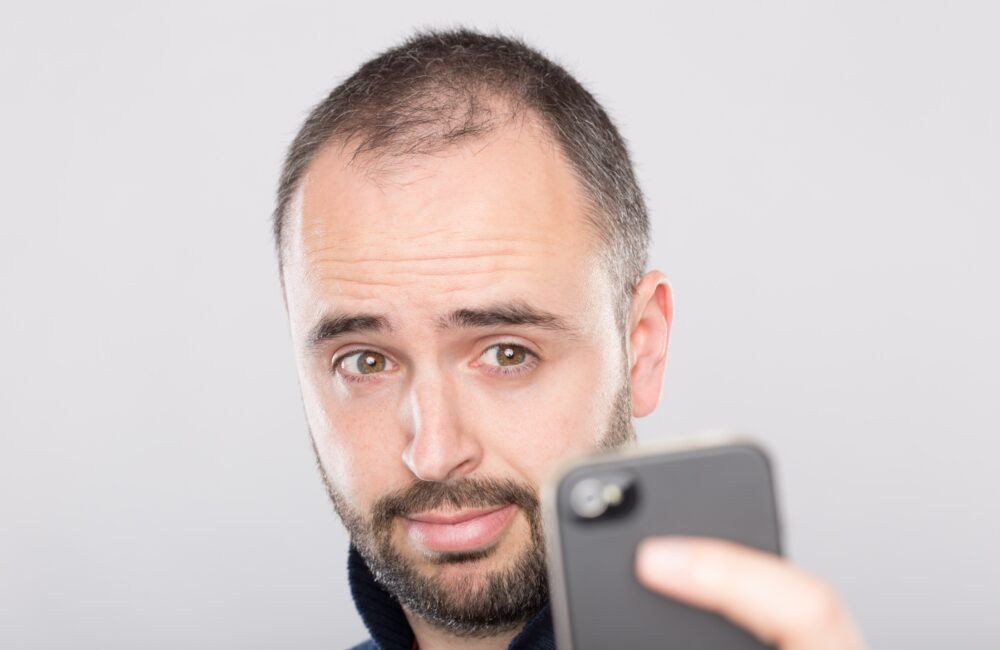 Wat je moet weten over haaruitval en haartransplantatie 22