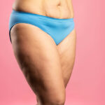 Alles wat je moet weten over lipoedeem 29 Alles wat je moet weten over lipoedeem 27