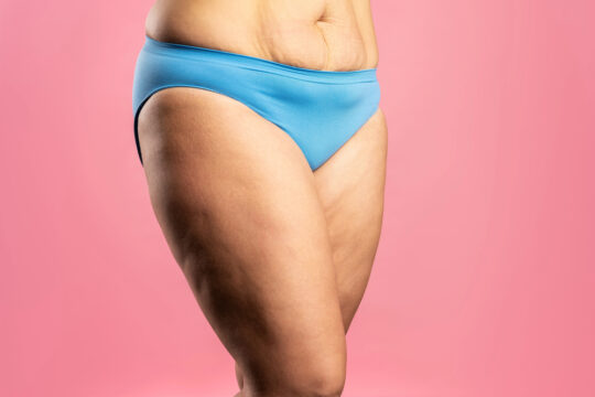 Alles wat je moet weten over lipoedeem 33