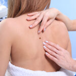 Waarom Nederlanders steeds vaker hun huid laten controleren 27 Waarom Nederlanders steeds vaker hun huid laten controleren 25